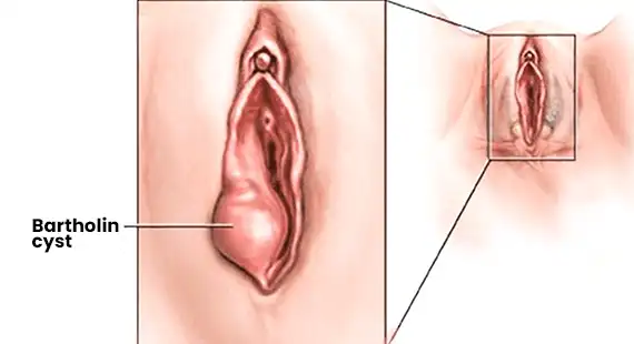 what is bartholin cyst